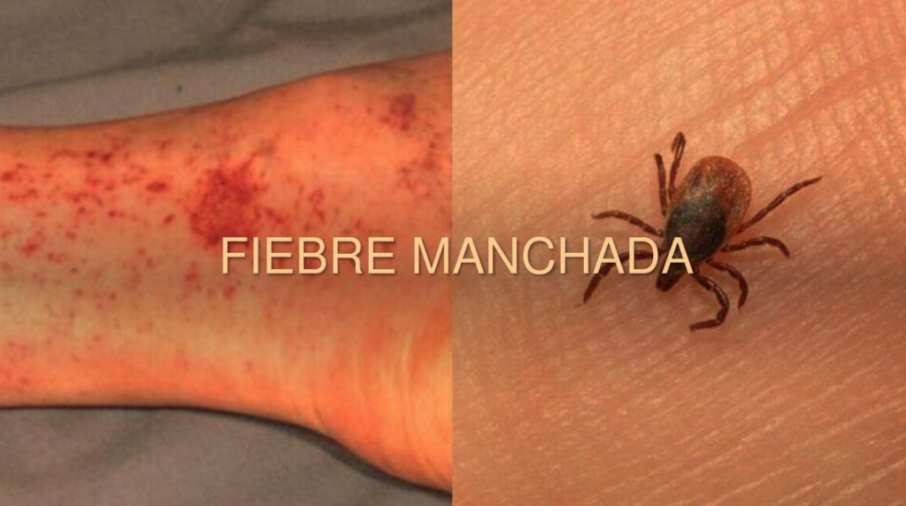 Acerca De La Fiebre Manchada De Las Montañas Rocosas