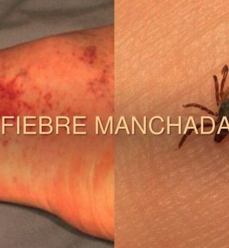 Acerca De La Fiebre Manchada De Las Montañas Rocosas