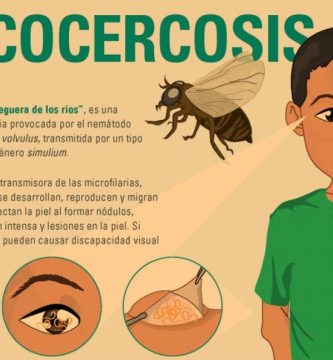 Cómo Prevenir La Oncocercosis - Ceguera De Los Ríos