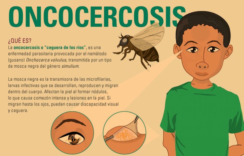 Cómo Prevenir La Oncocercosis - Ceguera De Los Ríos